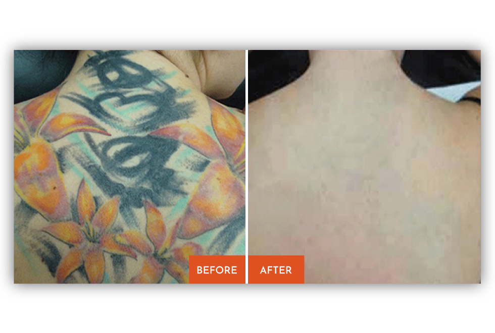 Laser Tattoo Removal in Kingston, NY - Ink Inc Tattooing